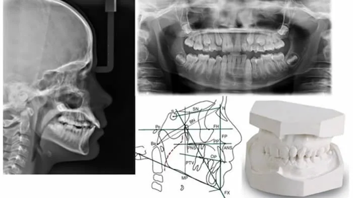 Estudio de ortodoncia con radiografías, cefalometría y modelos dentales