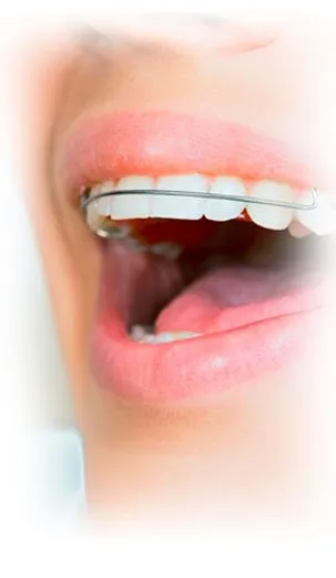 Sonrisa con ortodoncia estética transparente