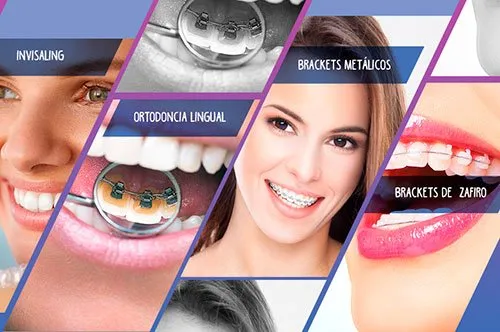 Tipos de ortodoncia: brackets metálicos, de zafiro, lingual e Invisalign